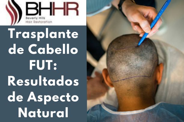 Trasplante de Cabello FUT: Resultados de Aspecto Natural